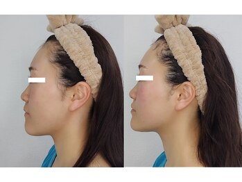 ソフィーム/エンビロンリフトフェイシャル