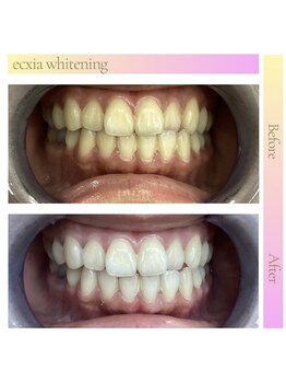 エクシアホワイトニング 仙台駅東口店/ホワイトニングビフォーアフター
