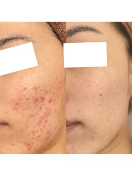 お肌想いラボ/【ニキビ】お客様症例写真