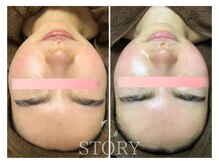 ストーリー(STORY)/ハーブピーリング専門店STORY