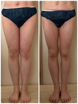 リノ(Lino)/【50代女性】パンパン脚スッキリ