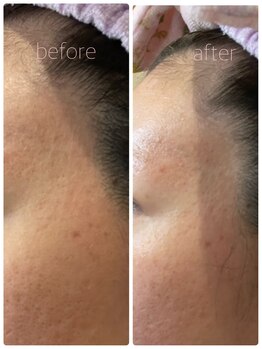 private salon KANASAの写真/頑固なイチゴ鼻や開き毛穴に!丁寧なケアで目指す毛穴レスな陶器肌へ☆自信溢れる素顔に♪11月限定5名様!