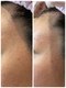 private salon KANASAの写真/頑固なイチゴ鼻や開き毛穴に!丁寧なケアで目指す毛穴レスな陶器肌へ☆自信溢れる素顔に♪11月限定5名様!