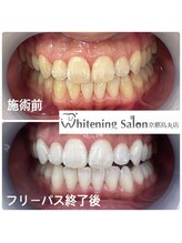 ホワイトニングサロン 京都烏丸店/ホワイトニング施術例