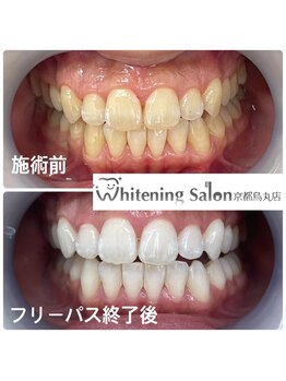 ホワイトニングサロン 京都烏丸店/ホワイトニング施術例