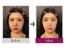 ビコツゼロ 青山(BIKOTSU ZERO)/小顔・フェイスラインの左右差