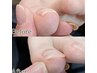 初回　巻き爪補正 親指１本　[六本木/広尾/麻布十番]