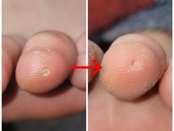 エーケーネイル(AKnail)/魚の目除去