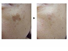 ビューティーガーデン(Beauty Garden)/シミケア