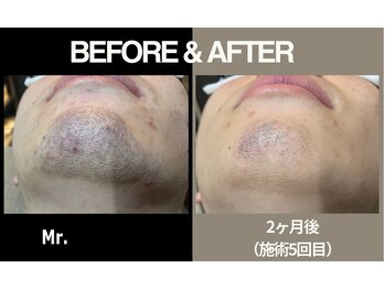 ミスター(Mr.)/【光脱毛】