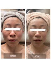 エメ(Aimer)/【40代EXフェイシャル結果☆】