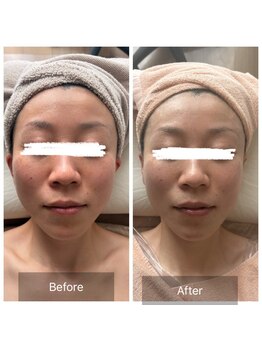 エメ(Aimer)/【40代EXフェイシャル結果☆】