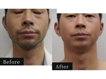 ハル(HAL)/ビフォーアフター/ヒゲ脱毛