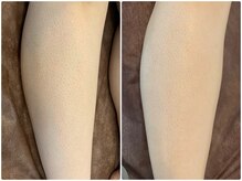 ベル(BeL)/足脱毛（女性）１２回