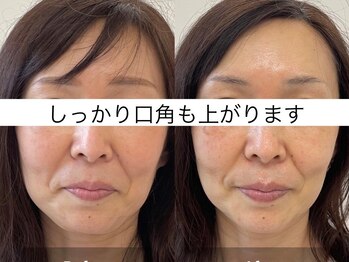 サクラ(SAKURA)/本厚木/フェイシャル/シミ