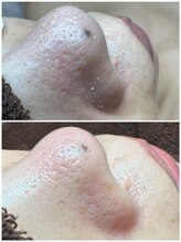 エクラ バイ シャンリィ(eclat by shanLy)/長年の毛穴詰まり解決！