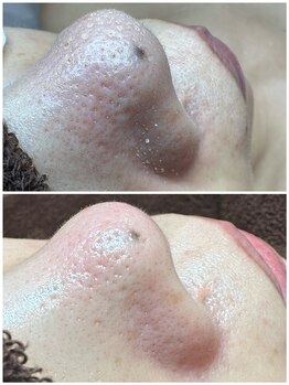 エクラ バイ シャンリィ(eclat by shanLy)/長年の毛穴詰まり解決！