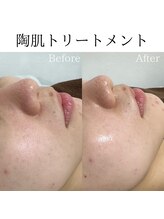 ビューティービューティー(BEAUTY BEAUTY)/陶肌トリートメント