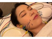 デルタエヌピー63+(δnp63+)/小顔鍼[小顔/薬院/フェイシャル]