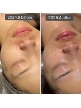 ロッタ エクリュ(Lotta ecru+)/REVI剥けないハーブピーリング