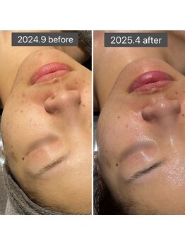 ロッタ エクリュ(Lotta ecru+)/REVI剥けないハーブピーリング