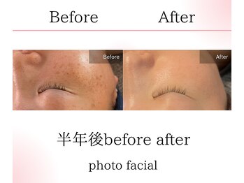 サロンツキ(salon tuki)/光フェイシャル症例/徳島シミ