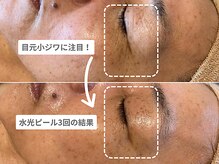 アンシャンテ 神戸元町店(Enchante)/毛穴洗浄ピーリングフェイシャル