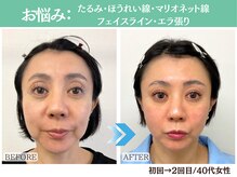 ナチュラルビューティーフェイス 横浜(NBF)/たるみ・ほうれい線など / 40代