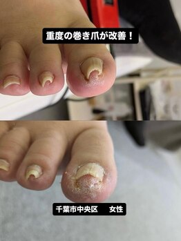 巻き爪じゅん 千葉駅前店/長年巻き爪に悩む方も効果を実感