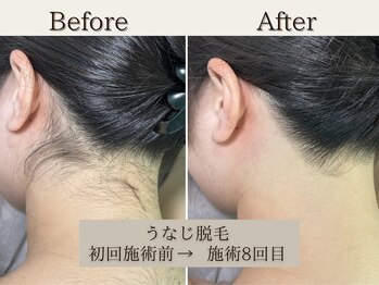 インベスト(INVEST)/うなじ脱毛