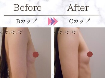メディカルサロン エム エム エム 大阪梅田グランドサロン(M.M.M)/【バストアップ例】　B→Cカップ