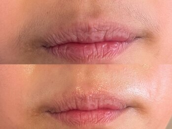 ディオーネ 西船橋駅前店(Dione)/はな下脱毛◇Before After