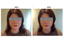 クレネ(Clene)/施術後の変化