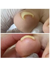 りく/巻き爪補正2カ所