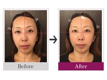 ビコツゼロ 青山(BIKOTSU ZERO)/小顔・目の高さ・口角の高さ