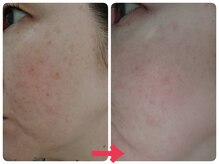 アズ(AZU)/40代before after