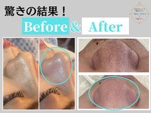 フローフシ∞/【毛穴洗浄BA】毛穴レスの美肌に