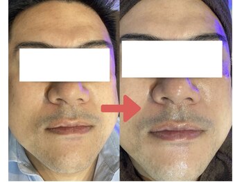 バニスター(Bannister)/【脱毛】メンズヒゲ脱毛