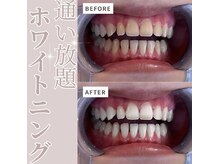 エクシアホワイトニング 仙台駅東口店/ホワイトニングビフォーアフター