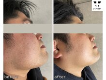 ヒゲ脱毛ビフォーアフター(8回)