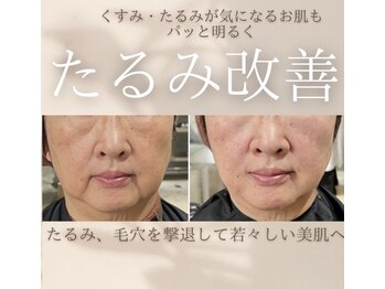 整顔院 横浜駅店の写真/驚きの小顔矯正たるみリフト！ほうれい線・たるみケアで、感動のリフトアップ効果をあなたに☆