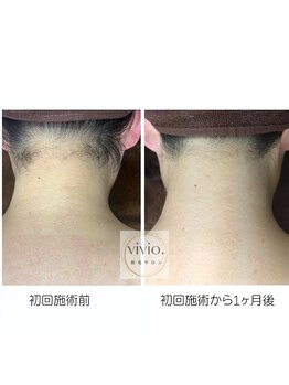 ヴィヴィオドット(vivio.)/うなじ脱毛