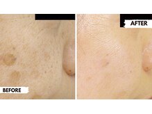 ロロメ(Rorome)/ビフォー/アフター(シミ)