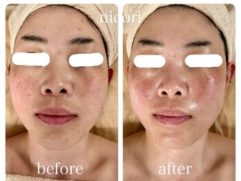 ニコリ(nicori)/小顔矯正　beforeとafter
