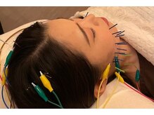 デルタエヌピー63+(δnp63+)/小顔鍼[小顔/薬院/フェイシャル]