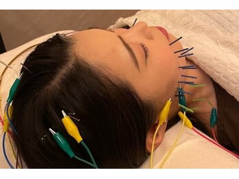 デルタエヌピー63+(δnp63+)/小顔鍼[小顔/薬院/フェイシャル]