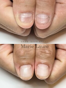 マリーロール 淀屋橋本店(Marie Laure)/自爪育成/深爪矯正/ネイルケア