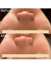 プラウ(Plau)/いちご鼻が気になる方に