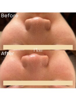 プラウ(Plau)/いちご鼻が気になる方に