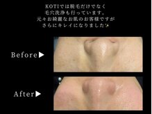 毛穴洗浄ビフォーアフター